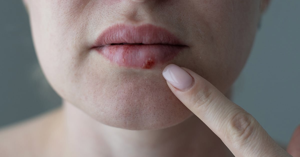 Después de casi treinta años, una pastilla vuelve a darle una oportunidad a los pacientes con herpes que se quedaron sin opciones