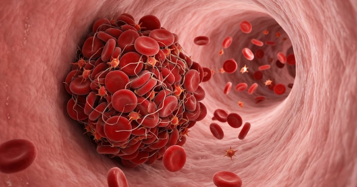 Cuando un coágulo cambia todo: las señales que el cuerpo envía antes de una embolia