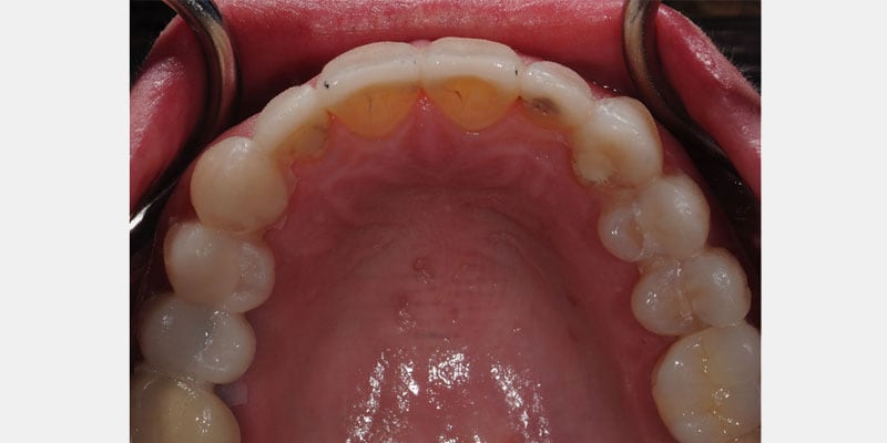 Carillas dentales: la filtración puede empezar en los bordes y avanzar en silencio